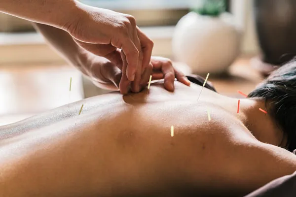 Person getting acupuncture 